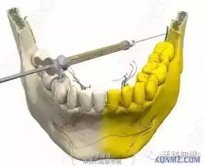 口腔拔牙图片,口腔拔牙麻醉多久消退