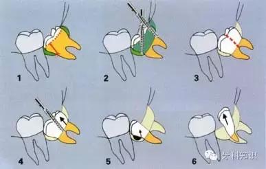 口腔拔牙图片,口腔拔牙麻醉多久消退