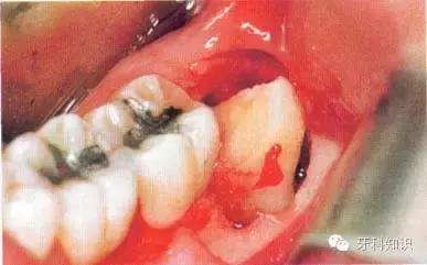 口腔拔牙图片,口腔拔牙麻醉多久消退