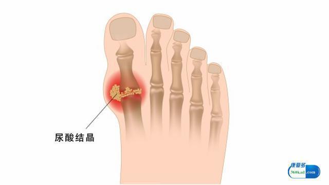 非布司他搭配什么药治痛风疗效好,痛风吃非布司他好还是苯溴马隆好