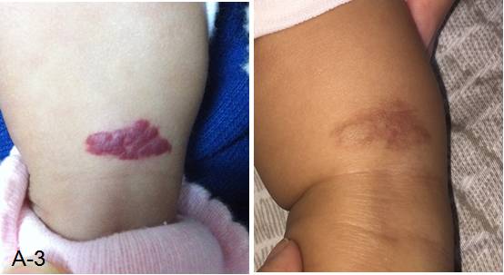 婴幼儿脸上有胎记怎么办,治疗婴幼儿红胎记哪里好