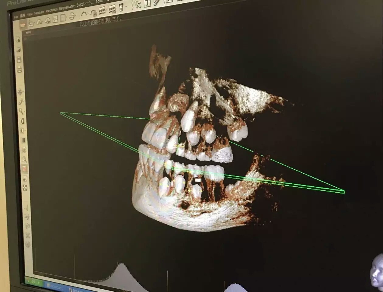 宝宝护牙的四大攻略,牙医爸爸给孩子修牙