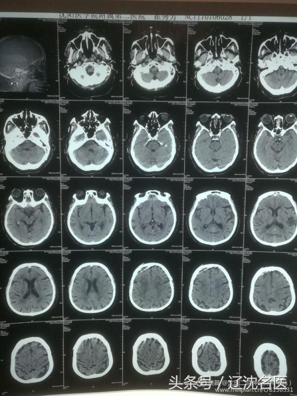 老人脑梗昏迷、大小便*禁失**，医生用这招救回一命！