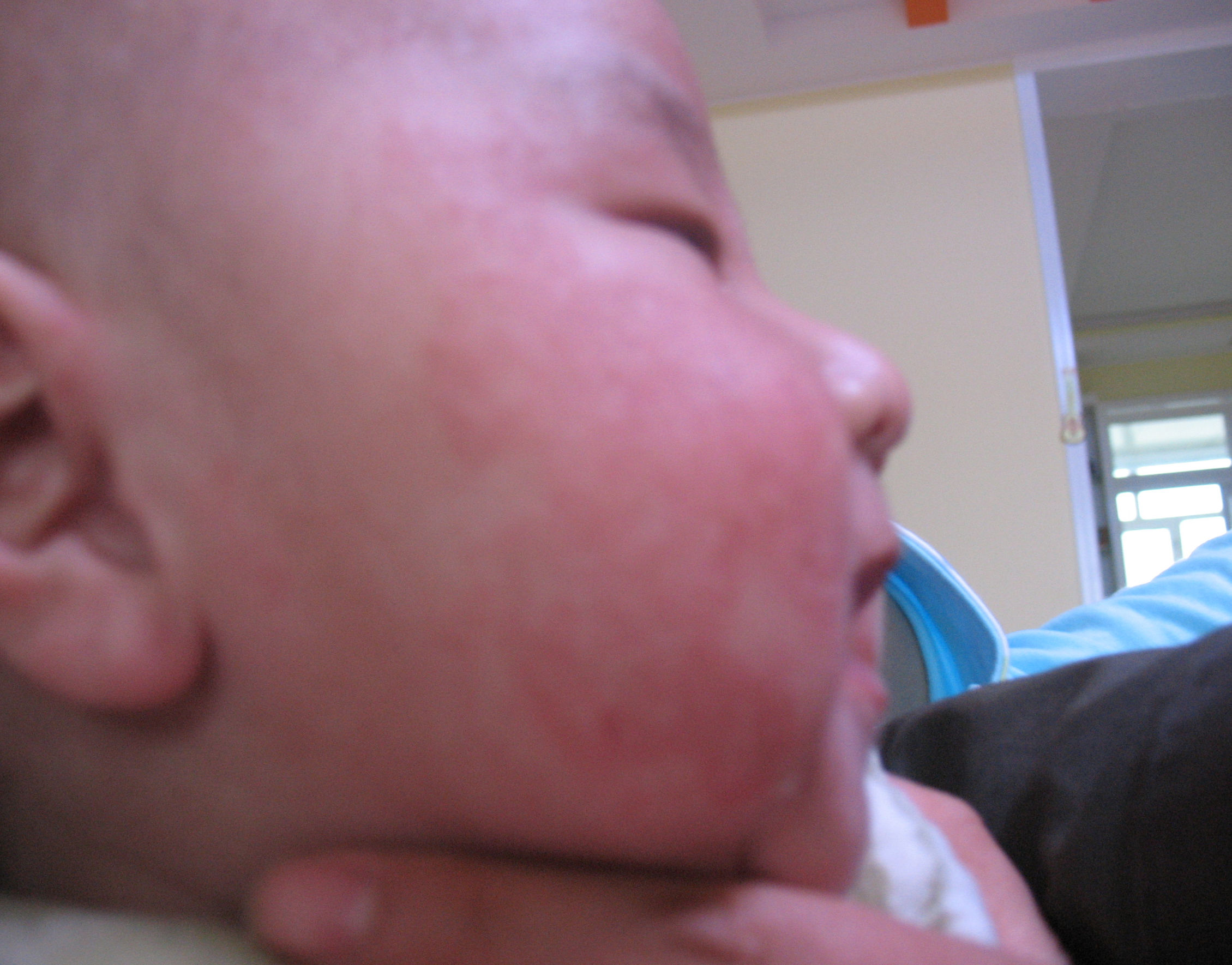 夏季疾病高发期，宝宝患了湿疹，该如何办？