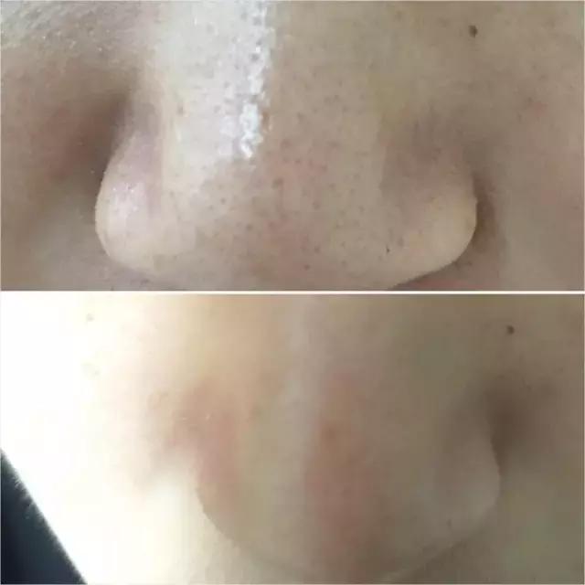 猪鼻贴去黑头,泰国进口去黑头鼻贴