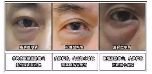 切除眼袋是唯一解决眼袋的方法,眼袋切除方法有哪些