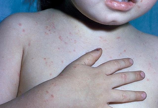 宝宝身上有螨虫包应该擦什么药,小孩身上有螨虫痒比较严重怎么治