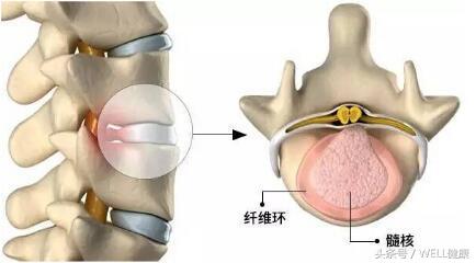 备孕腰椎间盘突出怎么办,腰椎间盘突出可以备孕吗