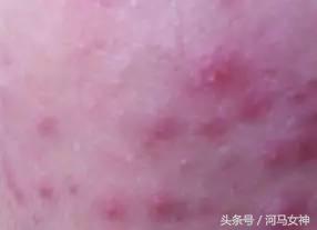 抗痘填坑,抗痘期间忌口大全