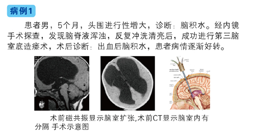 交通性脑积水首选神经内镜手术进行治疗