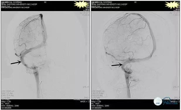 脑静脉窦狭窄做支架危险吗,静脉窦狭窄做支架后多久恢复