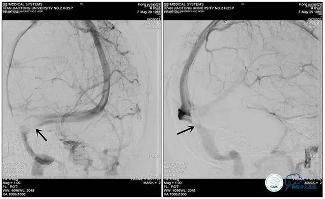 脑静脉窦狭窄做支架危险吗,静脉窦狭窄做支架后多久恢复