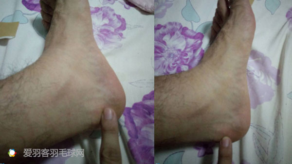 类风湿脚疼解决方法,80岁脚趾疼怎样治