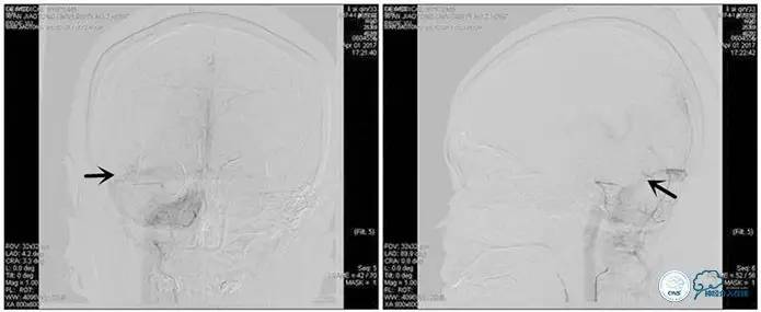 脑静脉窦狭窄做支架危险吗,静脉窦狭窄做支架后多久恢复