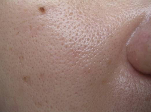 最全战痘攻略,战痘100种祛痘方法