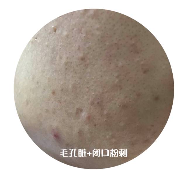 最全战痘攻略,战痘100种祛痘方法