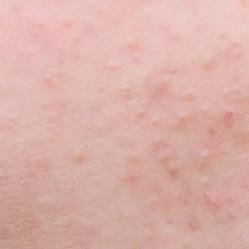 最全战痘攻略,战痘100种祛痘方法