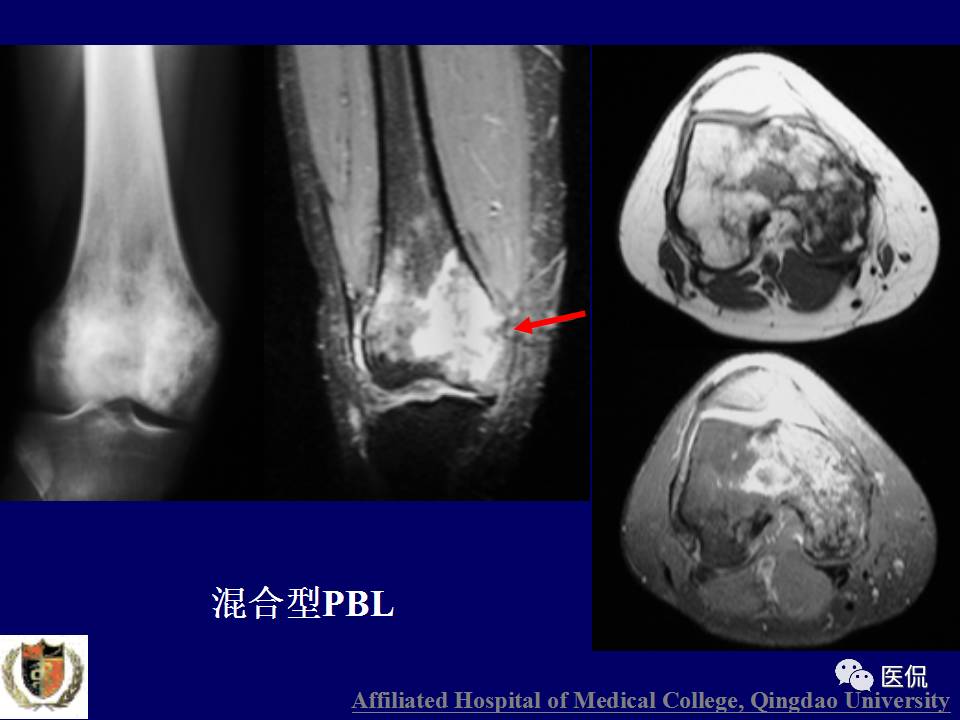 徐文坚老师精讲：原发性骨淋巴瘤影像学诊断医学影像精品PPT
