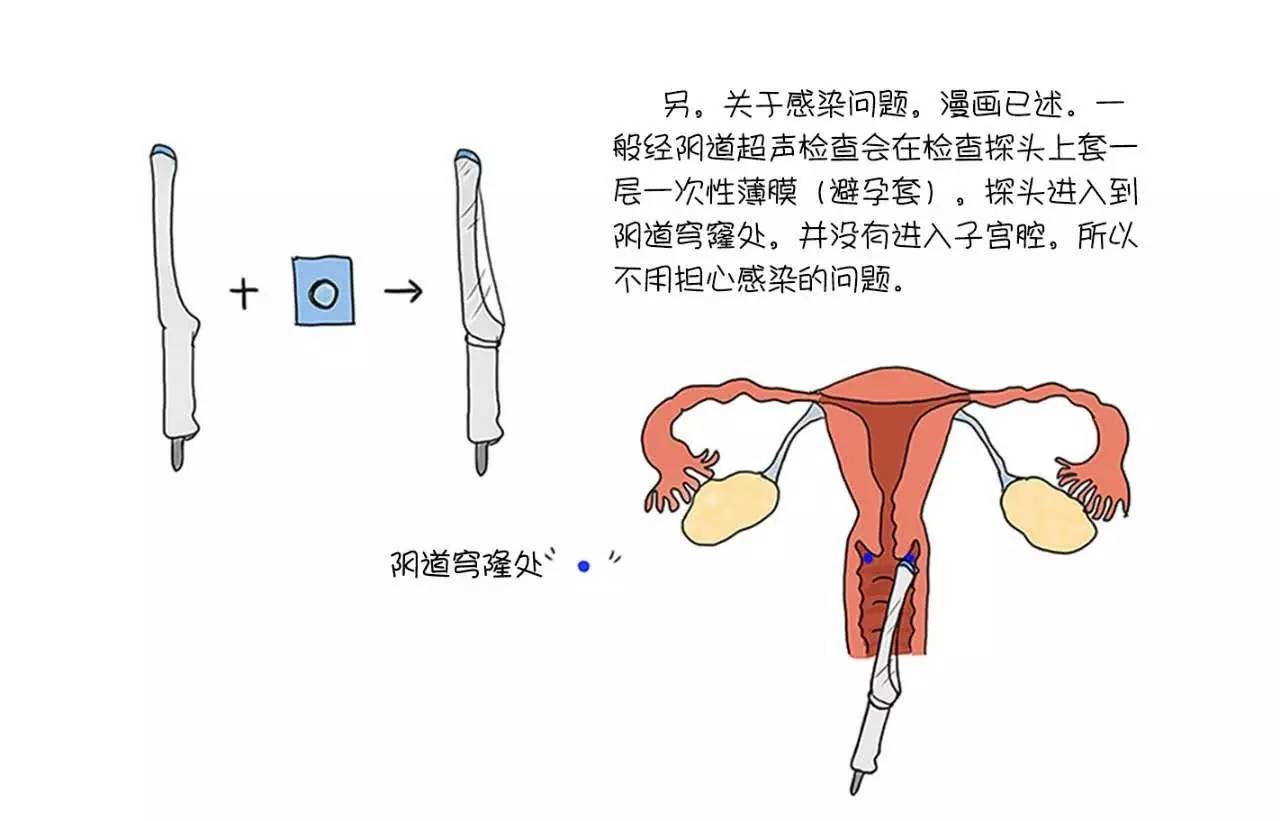 经期也可以做阴超吗,经期能做阴超吗
