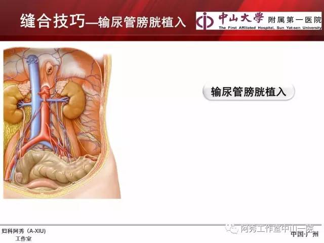 妇科腹腔镜下常用缝合技巧