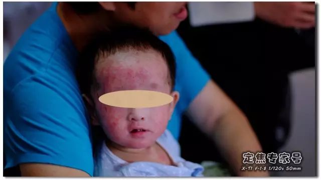 「热点」越是古老的疾病坑越多,一个湿疹能有多少坑把父母掉进去?