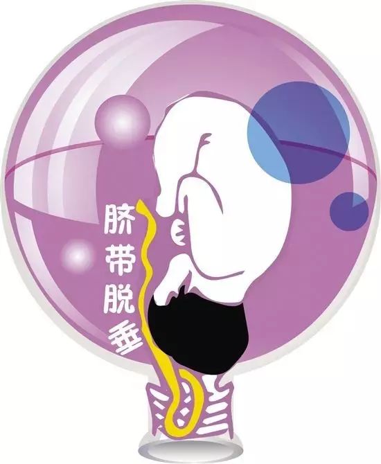 生死时速53分钟完整版视频,脐带脱垂有哪些前兆