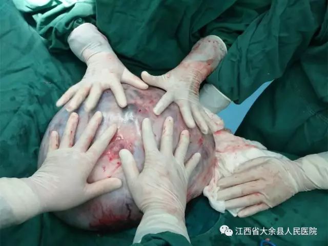 这疾病堪称女性噩梦，江西有人得了还不知情，一去医院吓坏了医生