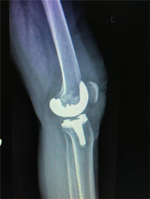 郴州市关节置换,湘雅附二膝关节置换手术
