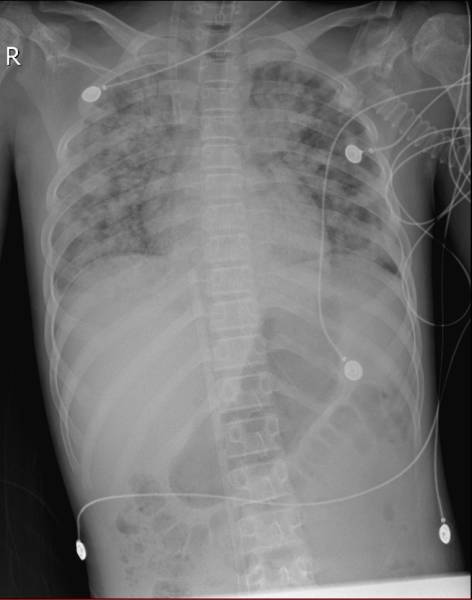 hiv最典型并发症,最新hiv感染治疗的消息