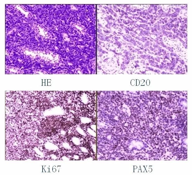 所有检查做完了不知道腹水原因,出现腹水是不是就是晚期了