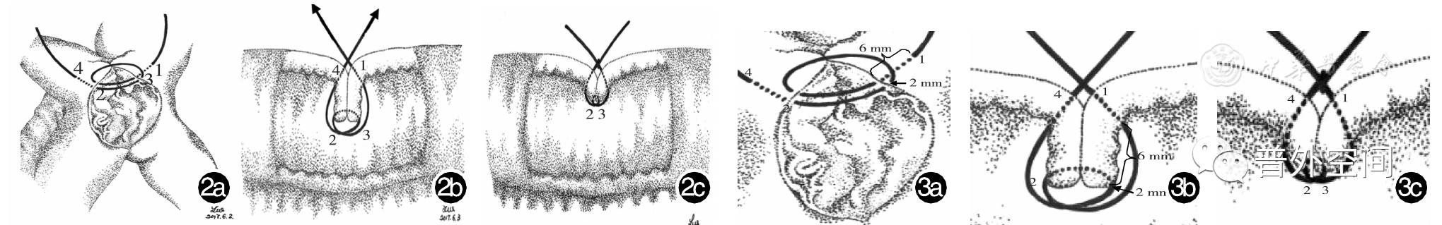 褥式垂直缝合法,垂直褥式缝合教学视频