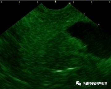 超声内镜美图攻略——动态范围与伪彩