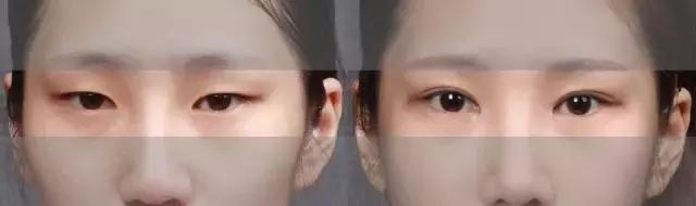 北京医院割双眼皮怎么样,北京三甲医院割双眼皮医生推荐