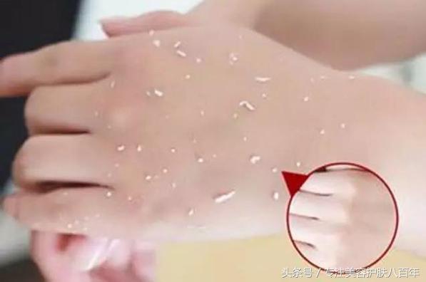 手上搓出的死皮,手上搓出角质层