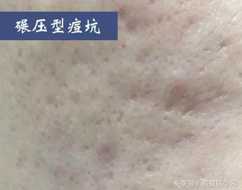 十几年痘坑痘印怎么祛除,十几年的水痘坑怎么填平