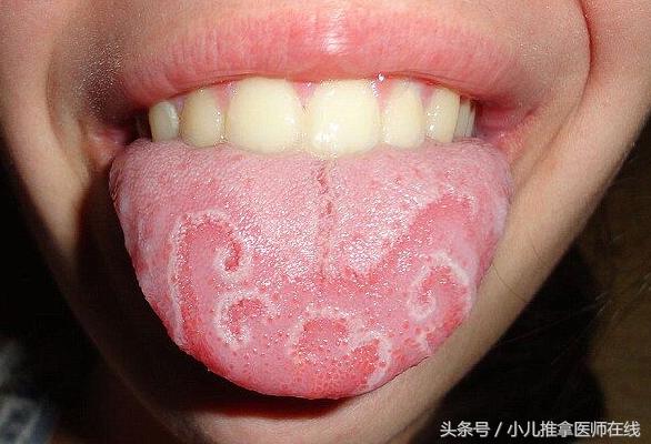 中医小儿推拿保健师：舌有花剥苔，名叫“地图舌”