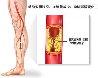 血管堵塞吃什么食物打通血管,什么食物软化血管和清理血管垃圾
