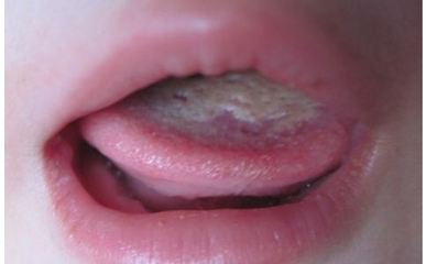 宝宝脾胃不好舌苔图片,婴幼儿脾胃好不好舌苔怎么看