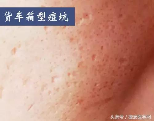 十几年痘坑痘印怎么祛除,十几年的水痘坑怎么填平