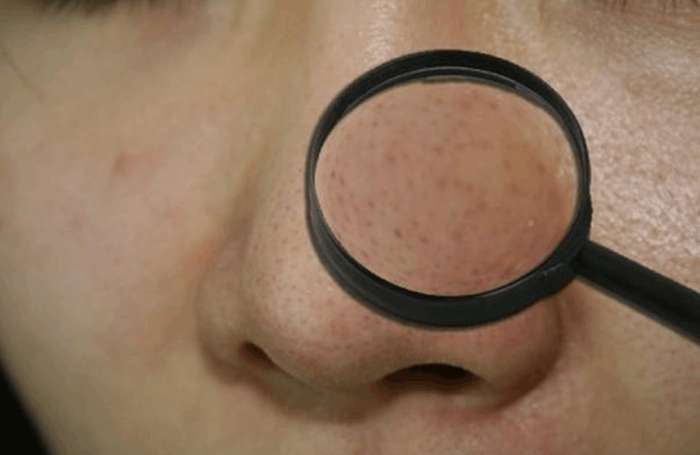 怎么让鼻头毛孔变小变干净,皮肤科鼻子毛孔粗大如何改善