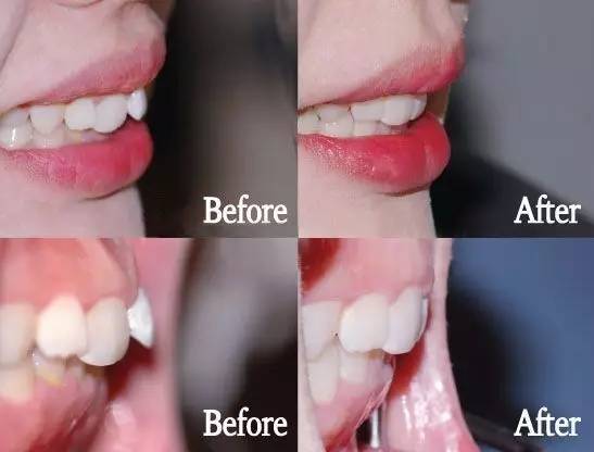 戴牙套为什么会矫正,牙套贵的和便宜的区别