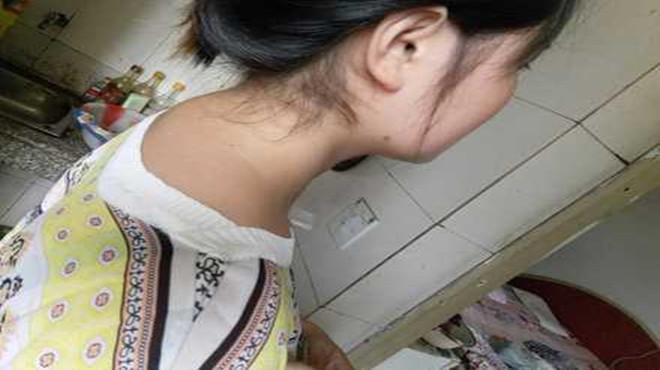 脖子下方有富贵包应注意哪些事项,孩子脖子后面有富贵包是怎么回事