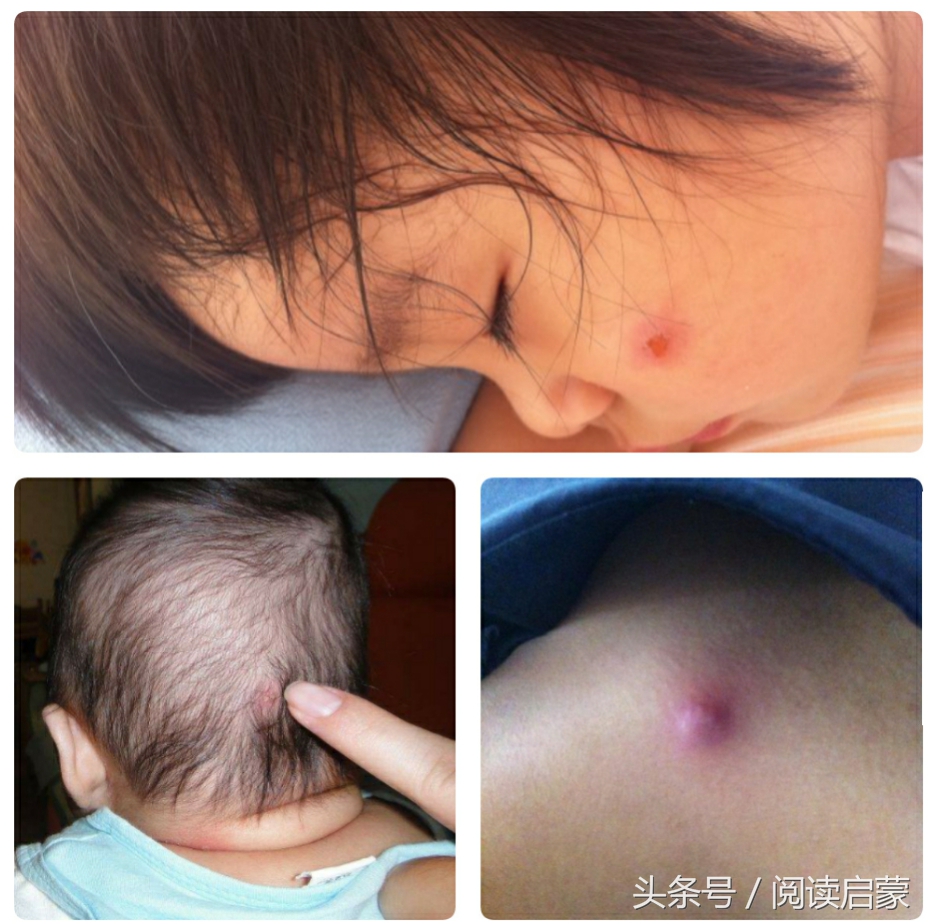 孩子头部起疙瘩并有脓包用什么,小孩头长脓包化脓能在自家处理吗