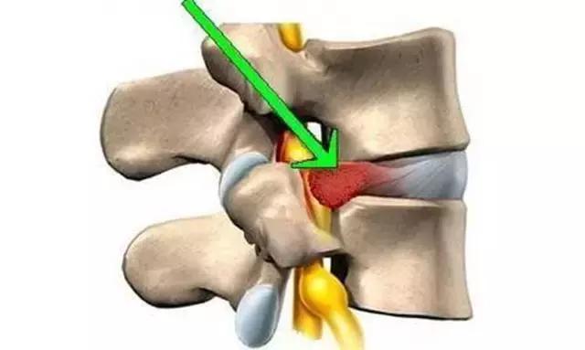 腰椎间盘突出贴哪个牌子膏药,小燕飞腰椎间盘突出锻炼方法