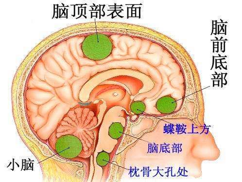 桥小脑角脑膜瘤术后后遗症,脑膜瘤术后放疗后遗症