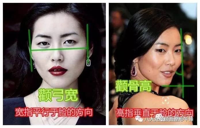 颧骨突出截骨手术的全过程,颧骨截骨多久恢复