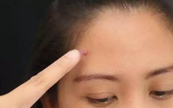 男子后脑勺长了几个疙瘩,男子颅内长活虫