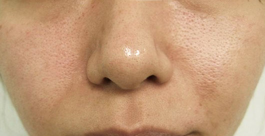 如何拯救毛孔粗大这篇科普说全了,毛孔粗大最简单有效的办法