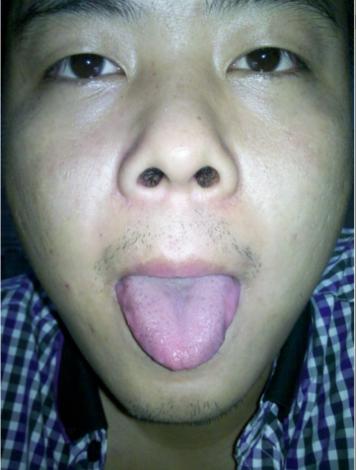 拔火罐出水泡是体内湿气重吗,拔火罐治疗湿气重一般多久能治好