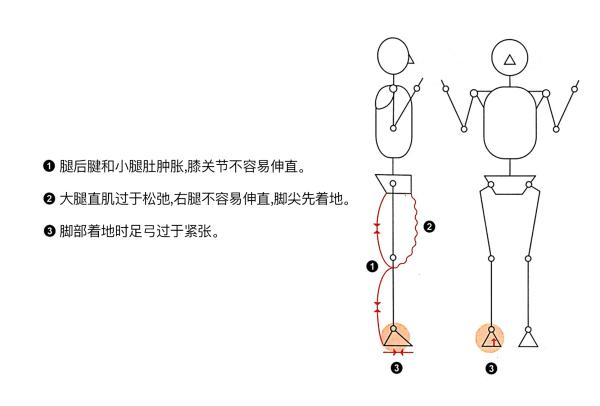 足底筋膜炎康复训练,如何改善脚底筋膜炎